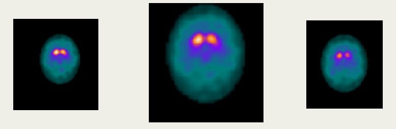 Three brain images are shown in a multicolored scan.